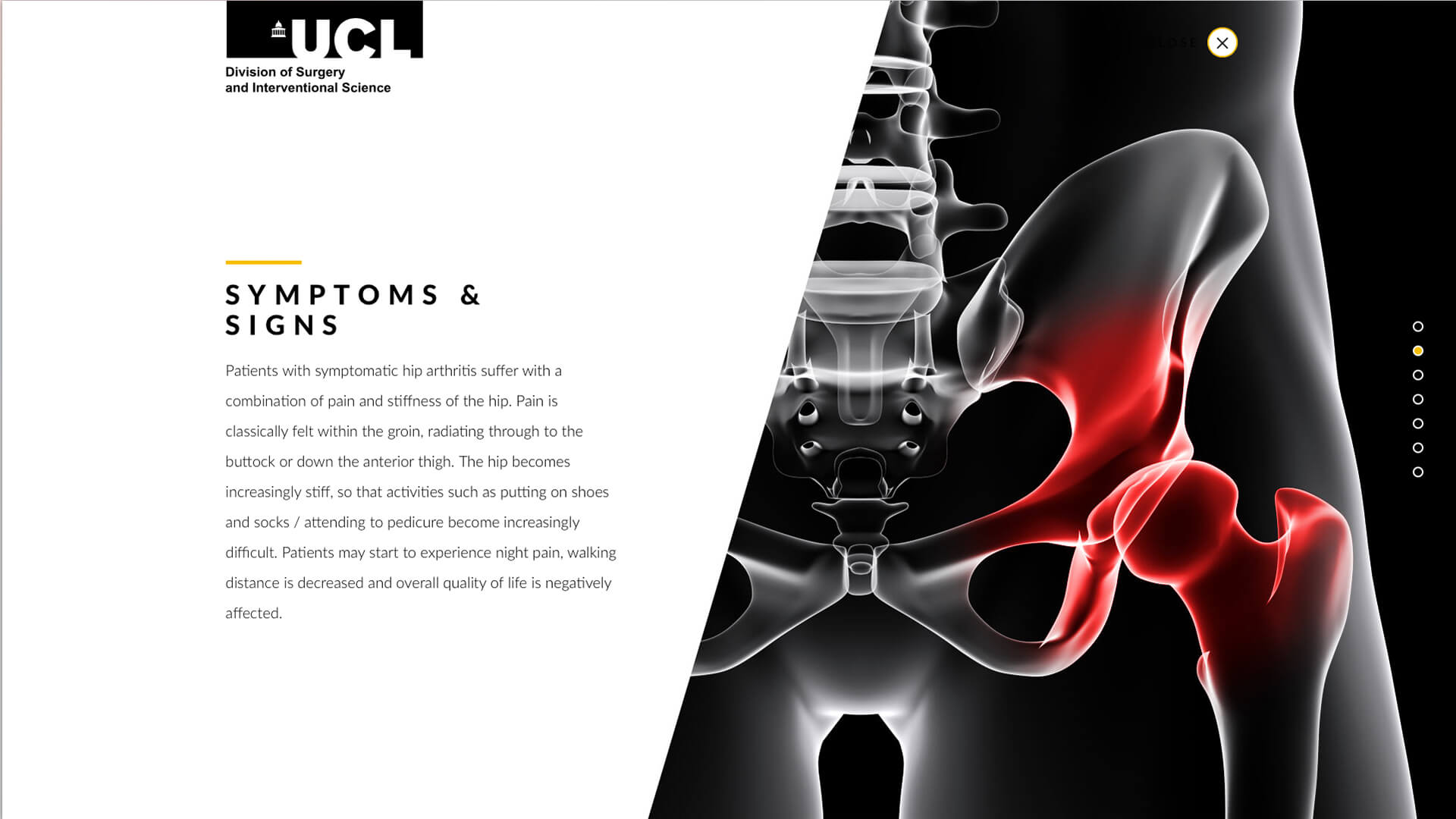 UCL Total Hip Replacement Video Guide image